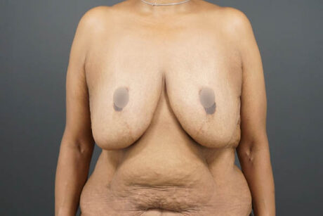 Breast Lift case #4593