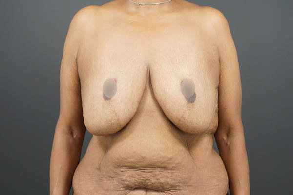 Breast Lift case #4593