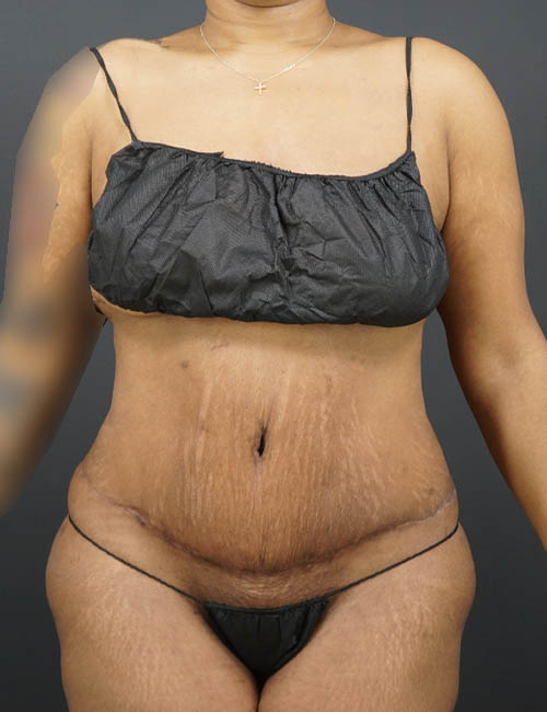 Tummy Tuck case #4567