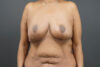 Breast Lift case #4593