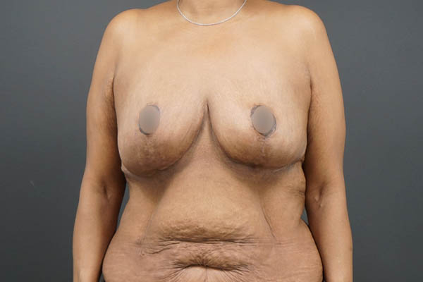 Breast Lift case #4593
