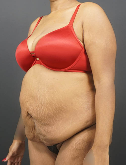 Tummy Tuck case #4567