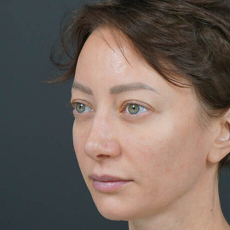 Eyelid Surgery case #4443