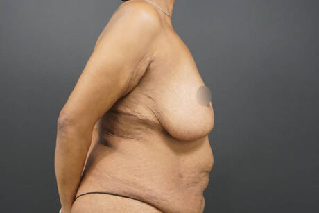 Breast Lift case #4593