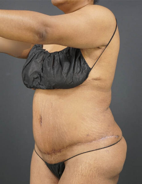 Tummy Tuck case #4567