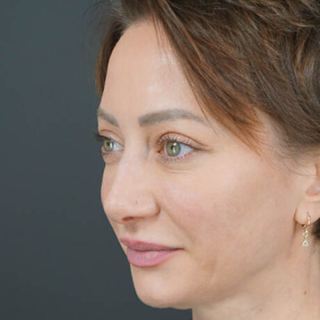 Eyelid Surgery case #4443