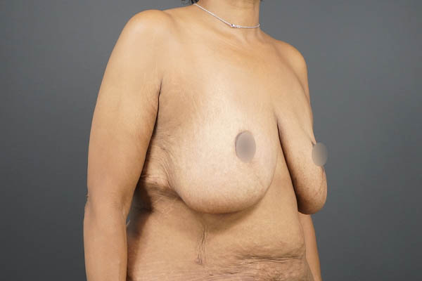 Breast Lift case #4593