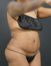 Tummy Tuck case #4567