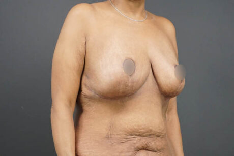 Breast Lift case #4593