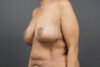 Breast Lift case #4593