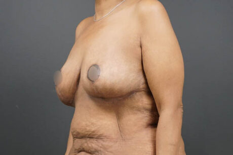 Breast Lift case #4593