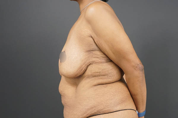 Breast Lift case #4593