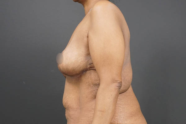 Breast Lift case #4593