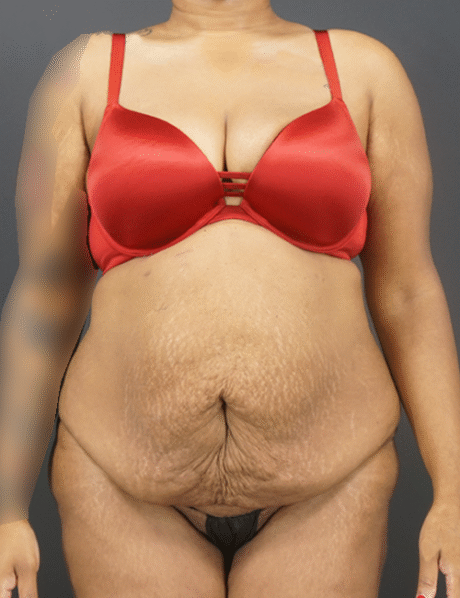 Tummy Tuck case #4567