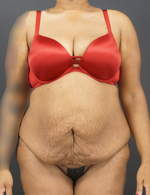 Tummy Tuck case #4567