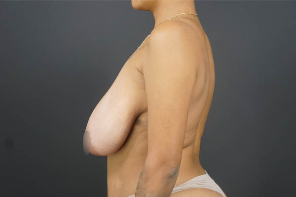 Breast Reduction case #4514