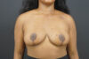 Breast Reduction case #4525