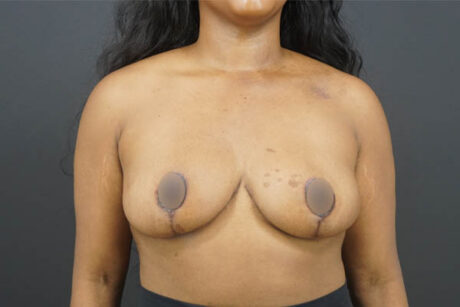 Breast Reduction case #4525