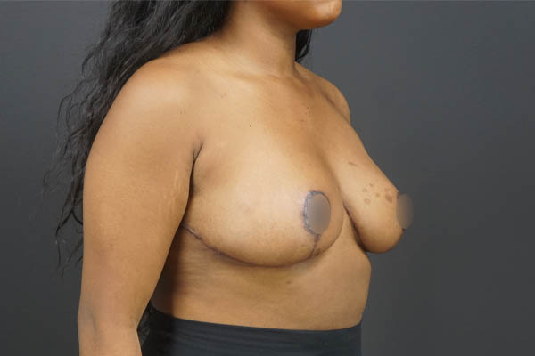 Breast Reduction case #4525