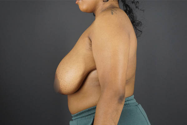 Breast Reduction case #4525