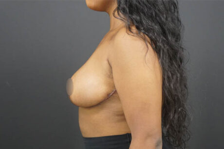 Breast Reduction case #4525