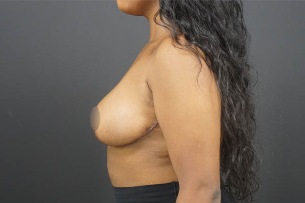 Breast Reduction case #4525