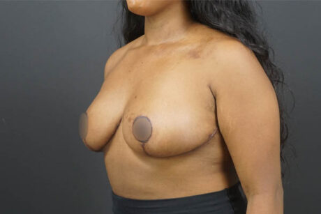 Breast Reduction case #4525