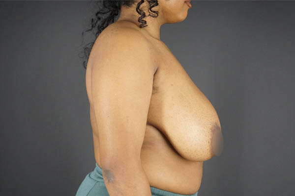 Breast Reduction case #4525