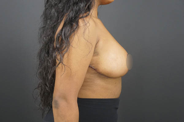 Breast Reduction case #4525