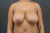 Breast Reduction case #4536
