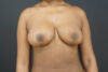 Breast Reduction case #4536