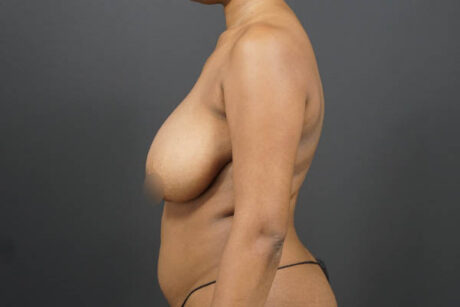 Breast Reduction case #4536