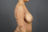 Breast Reduction case #4536