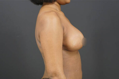 Breast Reduction case #4536