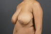 Breast Reduction case #4536