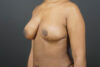 Breast Reduction case #4536