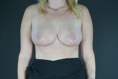 Breast Reduction case #4547