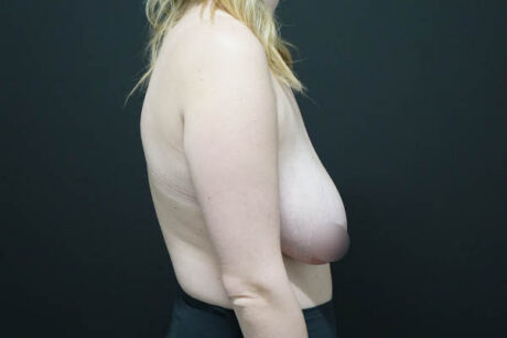 Breast Reduction case #4547