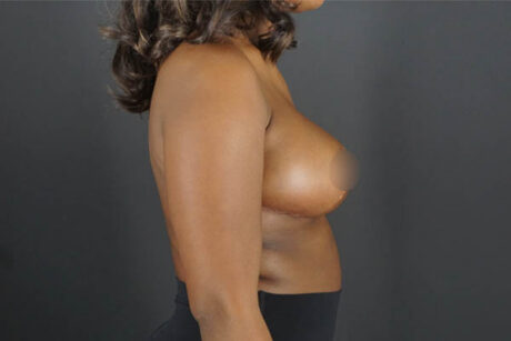 Breast Reduction case #4556