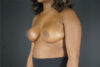 Breast Reduction case #4556