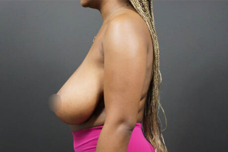 Breast Reduction case #4556
