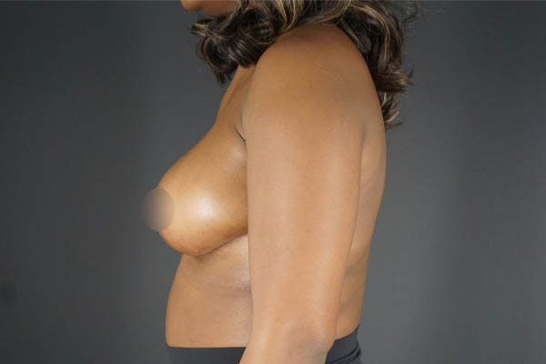 Breast Reduction case #4556