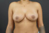 Breast Reduction case #4514