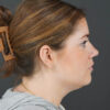Chin Liposuction case #4829