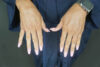 Fat transfer to hands case #4675
