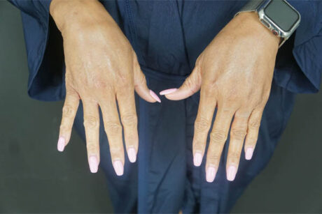 Fat transfer to hands case #4675