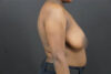 Breast Lift case #4682