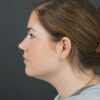 Chin Liposuction case #4829