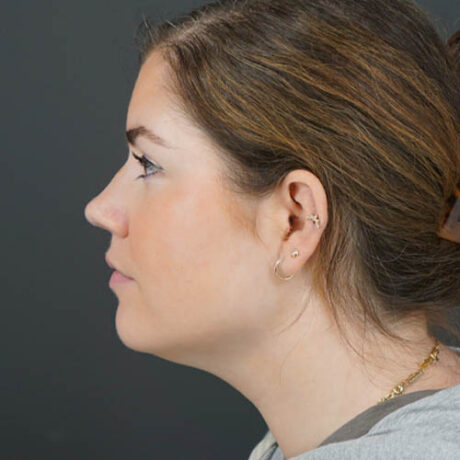 Chin Liposuction case #4829