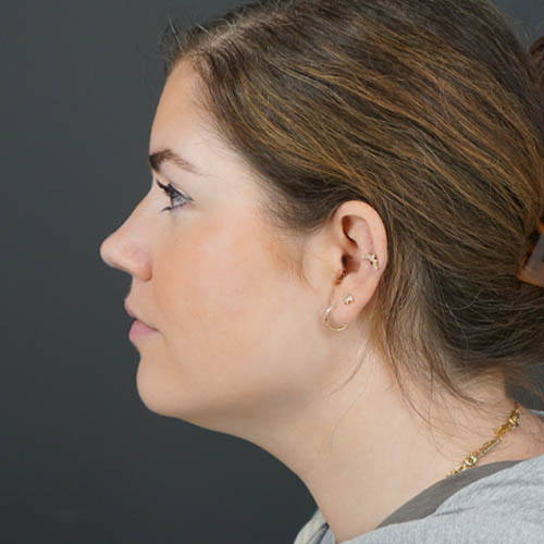 Chin Liposuction case #4829